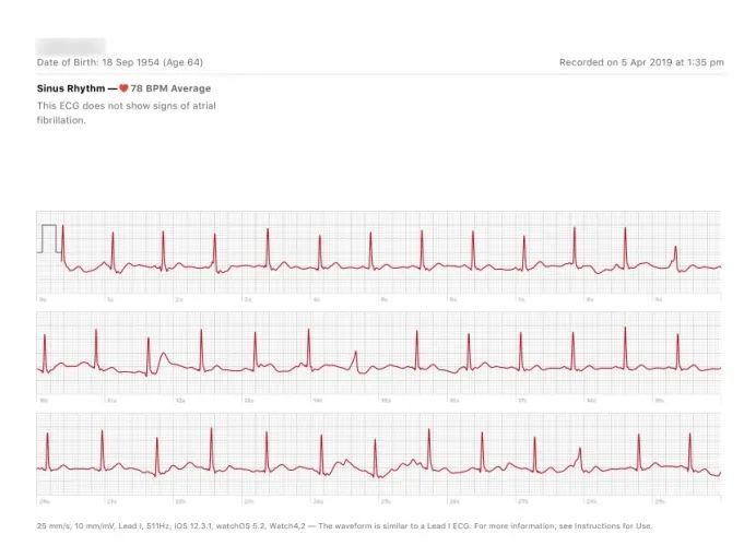 腾讯分分彩：为什么手表显示的“心率”很离谱？因为它根本没测心跳